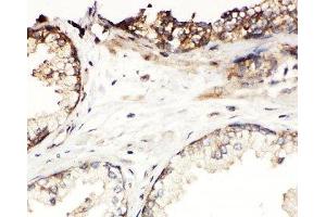 IHC-P: Kallikrein-11 antibody testing of human prostatic cancer tissue (Kallikrein 11 anticorps  (C-Term))