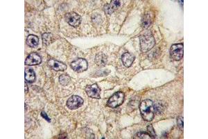 IHC analysis of FFPE human lung carcinoma tissue stained with CD14 antibody