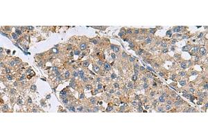 Immunohistochemistry of paraffin-embedded Human liver cancer tissue using MED31 Polyclonal Antibody at dilution of 1:100(x200) (MED31 anticorps)