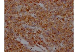 IHC image of ABIN7127835 diluted at 1:100 and staining in paraffin-embedded human glioma cancer performed on a Leica BondTM system. (Recombinant MAPT anticorps)