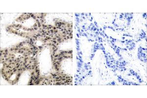 P-Peptide - +Immunohistochemical analysis of paraffin-embedded human breast carcinoma tissue using 4E-BP1 (phospho-Thr45) antibody. (eIF4EBP1 anticorps  (pThr45))
