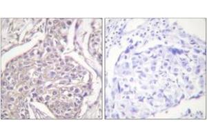 Immunohistochemistry analysis of paraffin-embedded human breast carcinoma, using HSP20 (Phospho-Ser16) Antibody.