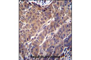 ARL2 Antibody (C-term) (ABIN650704 and ABIN2839229) immunohistochemistry analysis in formalin fixed and paraffin embedded human hepatocarcinoma followed by peroxidase conjugation of the secondary antibody and DAB staining.
