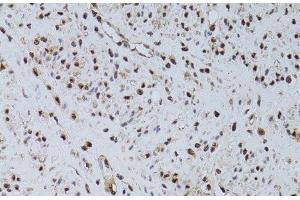 Immunohistochemistry of paraffin-embedded Human uterine cancer using HUS1 Polyclonal Antibody at dilution of 1:100 (40x lens). (HUS1 anticorps)