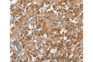 Immunohistochemistry of Human cervical cancer using CUL7 Polyclonal Antibody at dilution of 1:50 (Cullin 7 anticorps)
