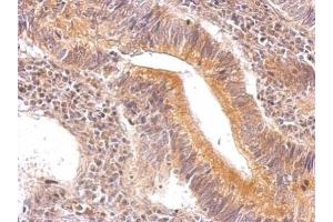 IHC-P Image ENO3 antibody detects ENO3 protein at cytosol on human gastric cancer by immunohistochemical analysis.