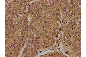 IHC image of ABIN7152998 diluted at 1:100 and staining in paraffin-embedded human liver cancer performed on a Leica BondTM system.