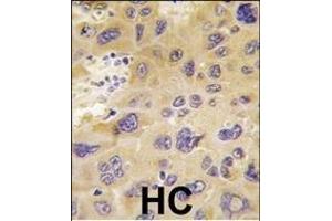 Formalin-fixed and paraffin-embedded human hepatocarcinoma tissue reacted with PFKFB1 antibody (N-term), which was peroxidase-conjugated to the secondary antibody, followed by DAB staining. (PFKFB1 anticorps  (N-Term))
