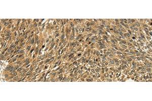Immunohistochemistry of paraffin-embedded Human lung cancer tissue using PSMD10 Polyclonal Antibody at dilution 1:40 (PSMD10 anticorps)
