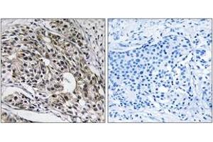 Immunohistochemistry analysis of paraffin-embedded human breast carcinoma tissue, using MRPL13 Antibody. (MRPL13 anticorps  (AA 121-170))