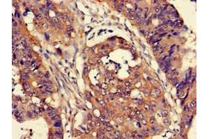 Immunohistochemistry of paraffin-embedded human colon cancer using ABIN7165226 at dilution of 1:100 (CUTA anticorps  (AA 33-150))