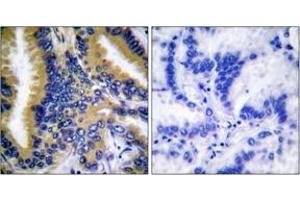 Immunohistochemistry analysis of paraffin-embedded human lung carcinoma tissue, using BIK (Ab-33) Antibody. (BIK anticorps  (AA 18-67))