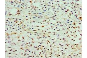Immunohistochemistry of paraffin-embedded human breast cancer using ABIN7147984 at dilution of 1:100 (COTL1 anticorps  (AA 1-142))