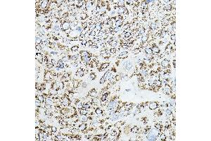 Immunohistochemistry of paraffin-embedded human esophageal cancer using VEGFB Rabbit pAb (ABIN6128909, ABIN6150090, ABIN6150092 and ABIN6216417) at dilution of 1:150 (40x lens).