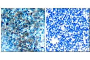 Immunohistochemical analysis of paraffin-embedded human tonsil carcinoma tissue, using VASP (Ab-238) antibody (E021172).