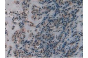 IHC-P analysis of Human Breast Cancer Tissue, with DAB staining. (DBH anticorps  (AA 335-571))