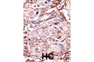 Formalin-fixed and paraffin-embedded human cancer tissue reacted with the primary antibody, which was peroxidase-conjugated to the secondary antibody, followed by AEC staining. (SMAD3 anticorps  (pSer213))