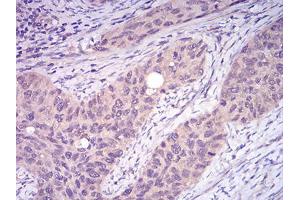 Immunohistochemical analysis of paraffin-embedded cervical cancer tissues using TRAF2 mouse mAb with DAB staining.