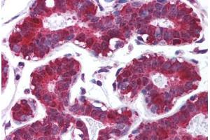 Human Breast (formalin-fixed, paraffin-embedded) stained with PDCD4 antibody ABIN213965 at 5 ug/ml followed by biotinylated goat anti-rabbit IgG secondary antibody ABIN481713, alkaline phosphatase-streptavidin and chromogen.