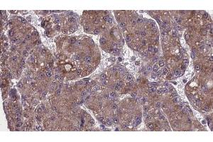 ABIN6274001 at 1/100 staining Human liver cancer tissue by IHC-P. (CD11b anticorps  (Internal Region))