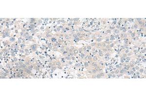 Immunohistochemistry of paraffin-embedded Human cervical cancer tissue using RALGAPA1 Polyclonal Antibody at dilution of 1:55(x200)