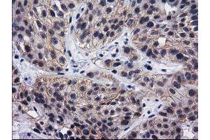 Immunohistochemical staining of paraffin-embedded Carcinoma of Human bladder tissue using anti-DNAJB1 mouse monoclonal antibody. (DNAJB1 anticorps)
