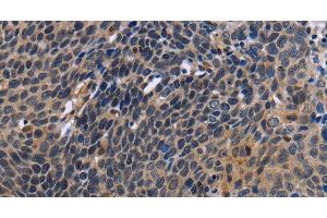 Immunohistochemistry of paraffin-embedded Human cervical cancer tissue using FSTL1 Polyclonal Antibody at dilution 1:30 (FSTL1 anticorps)