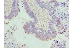 Immunohistochemistry of paraffin-embedded human ovarian cancer using ABIN7173667 at dilution of 1:100