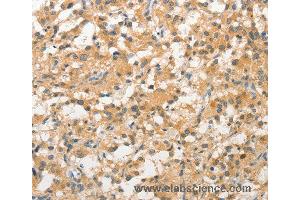 Immunohistochemistry of Human prostate cancer using STAM Polyclonal Antibody at dilution of 1:40
