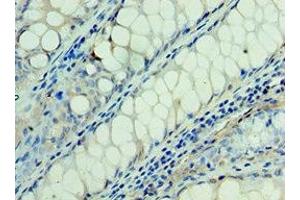 Immunohistochemistry of paraffin-embedded human colon cancer using ABIN7166935 at dilution of 1:100