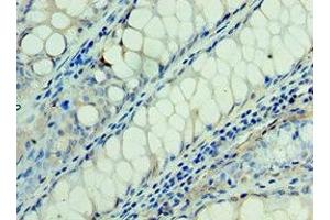 Immunohistochemistry of paraffin-embedded human colon cancer using ABIN7166935 at dilution of 1:100 (RSPO1 anticorps  (AA 21-263))