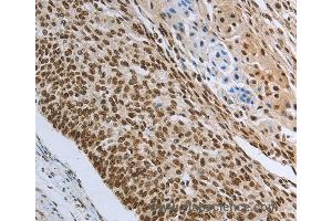 Immunohistochemistry of Human colon cancer using PRMT3 Polyclonal Antibody at dilution of 1:30 (PRMT3 anticorps)