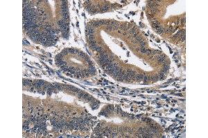 Immunohistochemistry of Human colon cancer using IL2RB Polyclonal Antibody at dilution of 1:60 (IL2 Receptor beta anticorps)