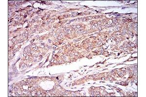 Immunohistochemical analysis of paraffin-embedded prostate cancer tissues using CAMK2G mouse mAb with DAB staining.