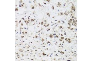 Immunohistochemistry of paraffin-embedded human gastric cancer using PPP1CC antibody. (PPP1CC anticorps  (AA 1-323))
