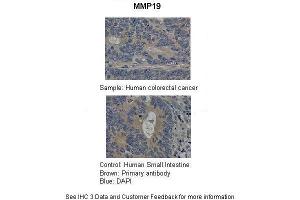 Sample Type :  Control-Human small intestine, Sample-Human colorectal cancer  Primary Antibody Dilution :  1:100  Secondary Antibody :  Biotinylated pig anti-rabbit+streptavidin-HRP  Color/Signal Descriptions :  MMP19: Brown DAPI:Blue  Gene Name :  MM  Submitted by :  Department of Pathology, Hospital de Carabineros de Chile, Santiago, Chile