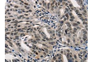 The image on the left is immunohistochemistry of paraffin-embedded Human ovarian cancer tissue using ABIN7190002(BPIFB1 Antibody) at dilution 1/40, on the right is treated with synthetic peptide. (BPIFB1 anticorps)