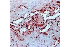 Formalin fixed paraffin embedded human angiosarcoma stained with VEGF antibody (VEGFA anticorps)