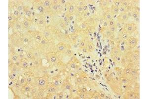 Immunohistochemistry of paraffin-embedded human liver cancer using ABIN7175178 at dilution of 1:100 (UVRAG anticorps  (AA 375-425))