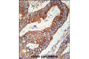 KLHL6 Antibody immunohistochemistry analysis in formalin fixed and paraffin embedded human colon carcinoma followed by peroxidase conjugation of the secondary antibody and DAB staining. (KLHL6 anticorps  (C-Term))