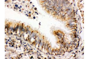 Anti- ERp57 Picoband antibody,IHC(P) IHC(P): Human Lung Cancer Tissue (PDIA3 anticorps  (C-Term))