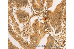 Immunohistochemistry of Human lung cancer using RPL26L1 Polyclonal Antibody at dilution of 1:30 (RPL26L1 anticorps)