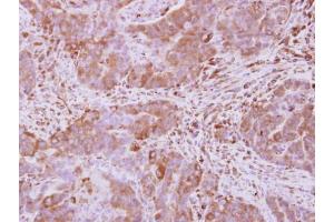IHC-P Image Immunohistochemical analysis of paraffin-embedded human colon carcinoma, using Optineurin, antibody at 1:500 dilution.