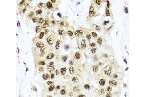 Immunohistochemistry of paraffin-embedded Human lung cancer using TET2 Polyclonal Antibody at dilution of 1:100 (40x lens).