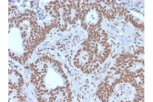 Formalin-fixed, paraffin-embedded human colon carcinoma stained with NRF1 Mouse Monoclonal Antibody (NRF1/2609). (NFE2L1 anticorps)