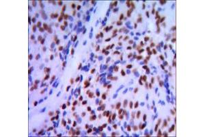 Immunohistochemical analysis of paraffin-embedded pancreatic cancer, using GATA1 mouse mAb with DAB staining. (GATA1 anticorps)