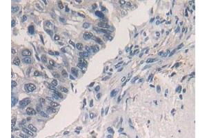 Detection of PLN in Human Prostate cancer Tissue using Polyclonal Antibody to Phospholamban (PLN)