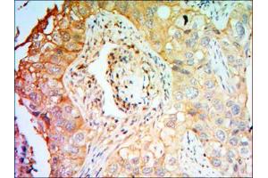 Immunohistochemical analysis of paraffin-embedded lung cancer tissues using PTK7 antibody with DAB staining. (PTK7 anticorps)