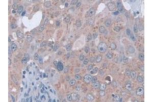 IHC-P analysis of Human Breast cancer Tissue, with DAB staining. (D2HGDH anticorps  (AA 56-232))
