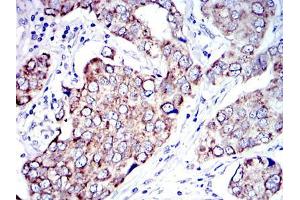 Immunohistochemical analysis of paraffin-embedded human breast cancer tissues using AIF mouse mAb with DAB staining.